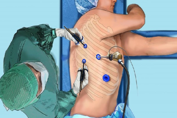 Thoracoscopy
